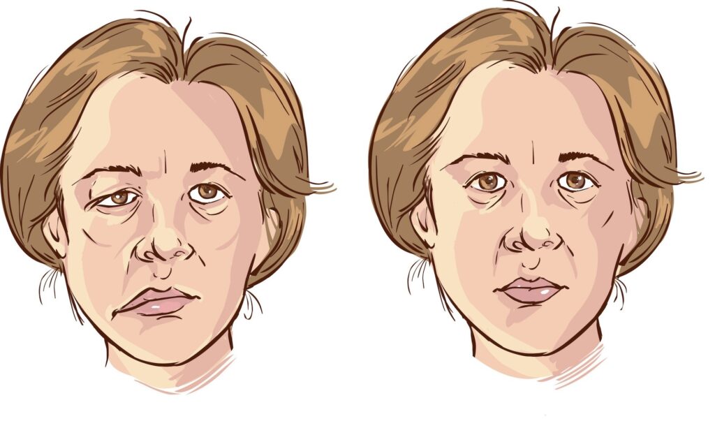 Bell's palsy treatment at Laser For Pain